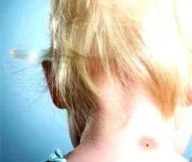 Дезинсекция от клещей - вариант 4