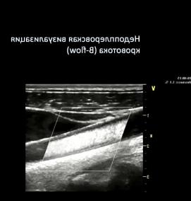 Визуализация кровотока - вариант 2