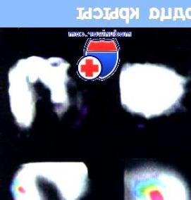 радионуклидная визуализация - вариант 3