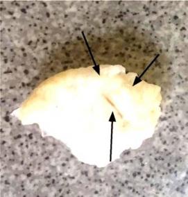 Визуализация лимфатических узлов - вариант 1