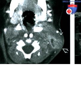 Визуализация лимфатических узлов - вариант 3